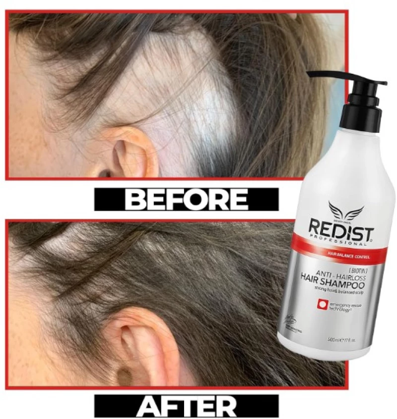 ΣΑΜΠΟΥΑΝ ΚΑΤΑ ΤΗΣ ΤΡΙΧΟΠΤΩΣΗΣ REDIST HAIRLOSS 500ml
