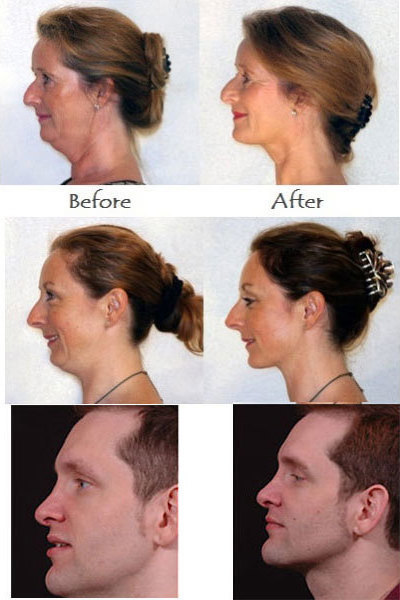 Σύσφιξης Επιδερμίδας Του Προσώπου